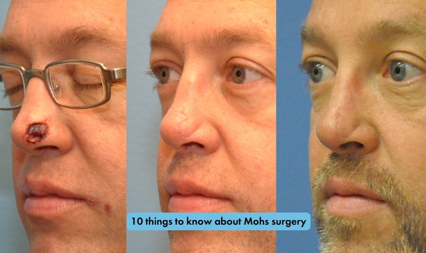Facts About Mohs Surgery