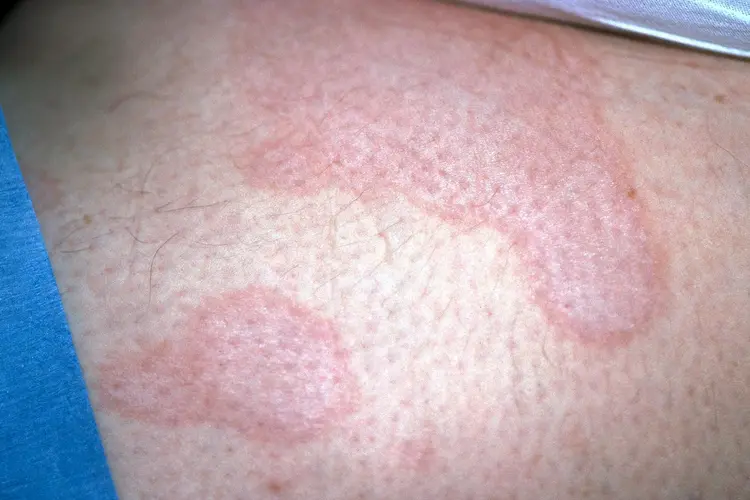 SCLE Symptom Treatment 2