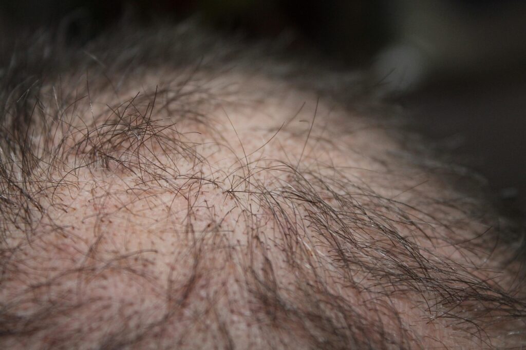 hair, man, hair loss, head, hair loss, hair loss, hair loss, hair loss, hair loss
