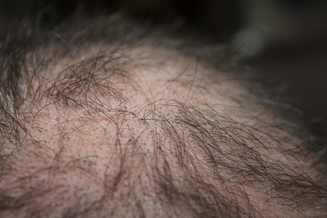 hair, man, hair loss, head, hair loss, hair loss, hair loss, hair loss, hair loss