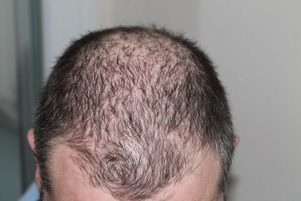 hair, man, hair loss, head, hair loss, hair loss, hair loss, hair loss, hair loss
