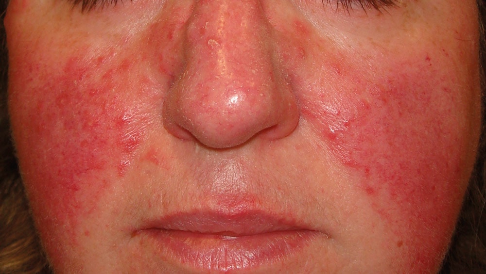 Rosacea