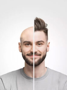 Balding and hair regrowth comparison on a man’s head