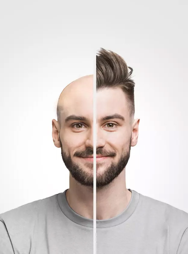 Balding and hair regrowth comparison on a man’s head