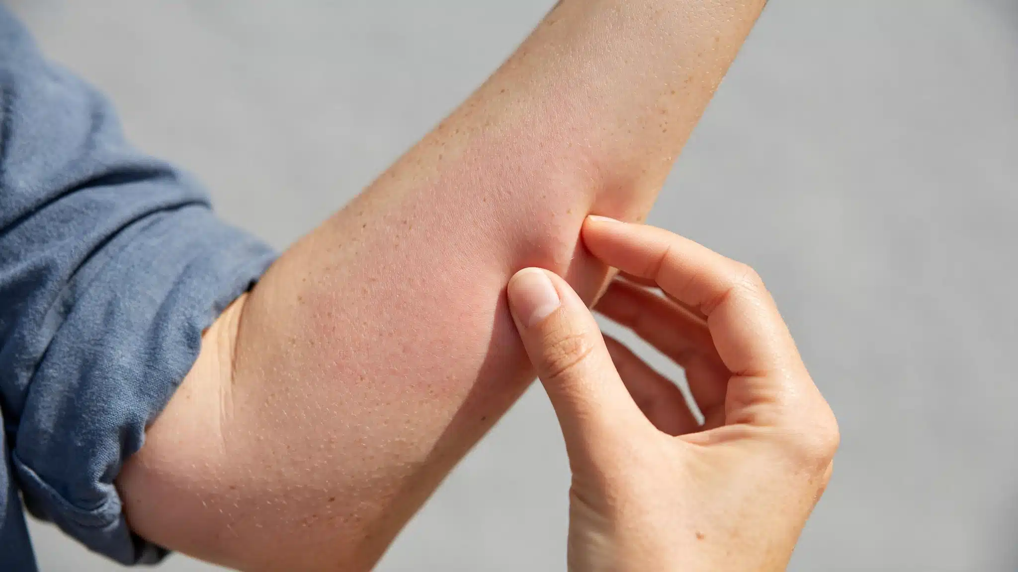 Checking skin for a modafinil rash that needs same-day care